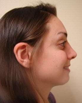 Facial Implants Before & After Patient #346