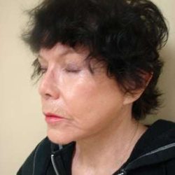 Facelift Before & After Patient #353