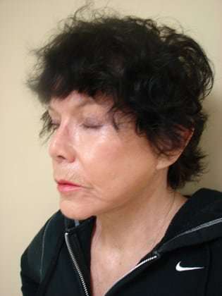 Facelift Before & After Patient #353
