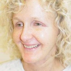 Facelift Before & After Patient #358