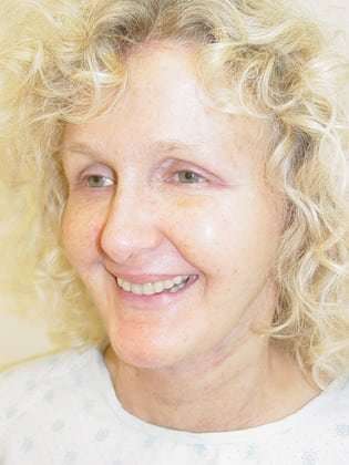 Facelift Before & After Patient #358