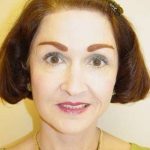 Facelift Before & After Patient #361