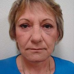 Facelift Before & After Patient #365