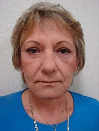 Facelift Before & After Patient #365