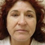 Facelift Before & After Patient #372