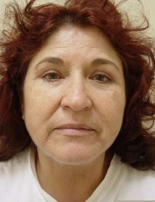 Facelift Before & After Patient #372