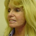 Facelift Before & After Patient #375