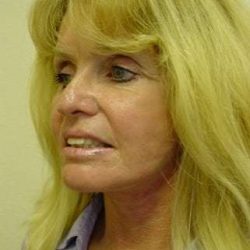 Facelift Before & After Patient #375