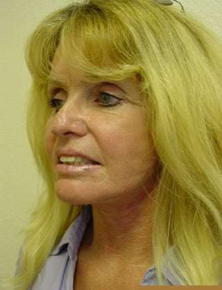 Facelift Before & After Patient #375