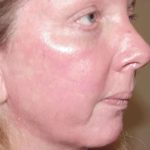 Laser Resurfacing Before & After Patient #146