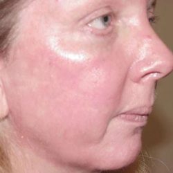 Laser Resurfacing Before & After Patient #146