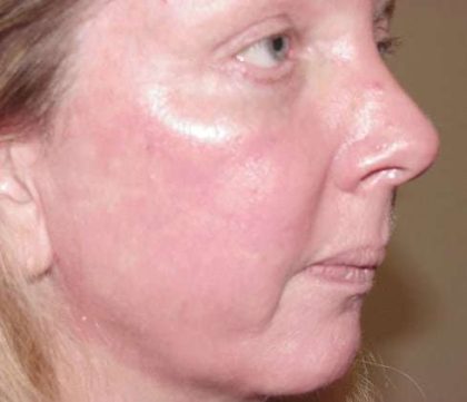 Laser Resurfacing Before & After Patient #146