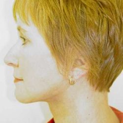 Facelift Before & After Patient #379