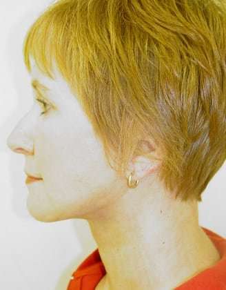 Facelift Before & After Patient #379