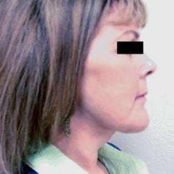 Facelift Before & After Patient #384