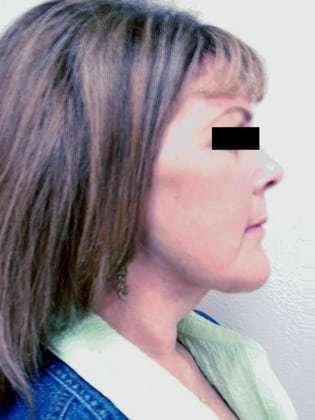 Facelift Before & After Patient #384