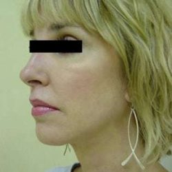 Facelift Before & After Patient #387