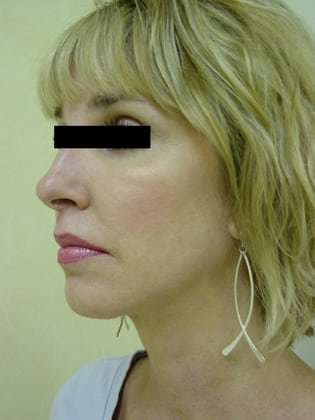 Facelift Before & After Patient #387
