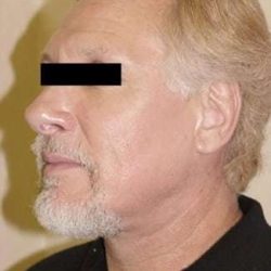 Facelift Before & After Patient #395
