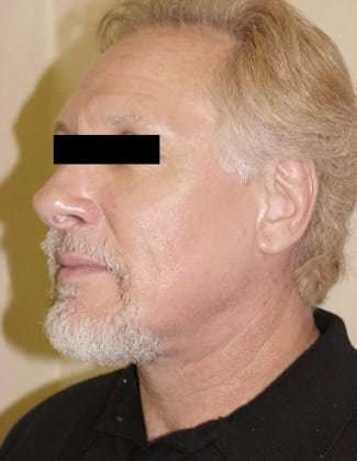 Facelift Before & After Patient #395