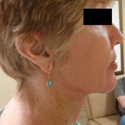 Facelift Before & After Patient #398