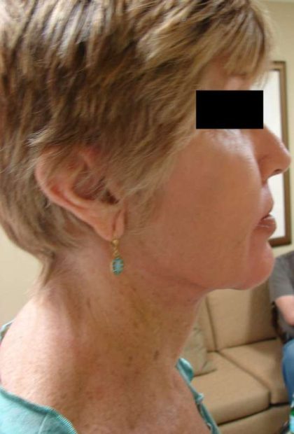 Facelift Before & After Patient #398