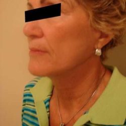 Facelift Before & After Patient #401