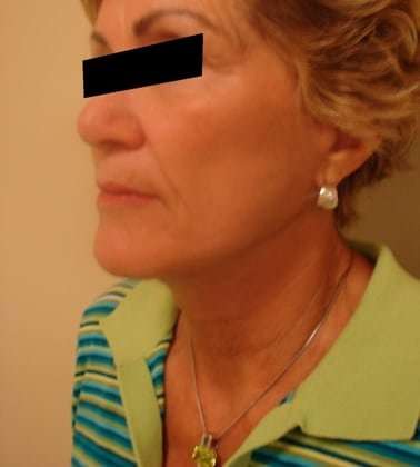 Facelift Before & After Patient #401