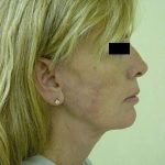Facelift Before & After Patient #405