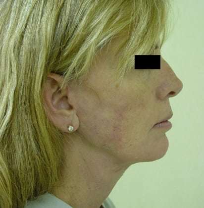 Facelift Before & After Patient #405