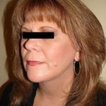 Facelift Before & After Patient #408