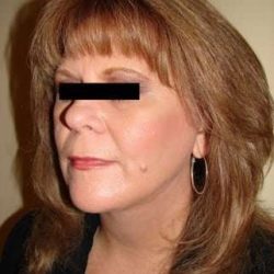 Facelift Before & After Patient #408