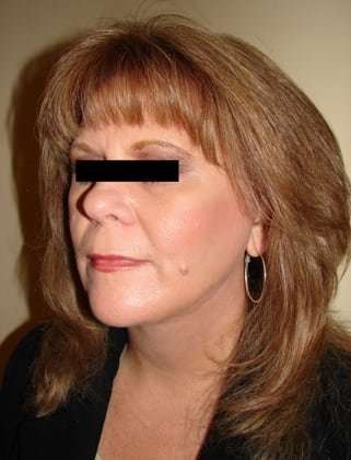 Facelift Before & After Patient #408
