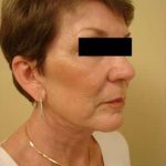 Facelift Before & After Patient #411