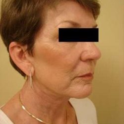 Facelift Before & After Patient #411