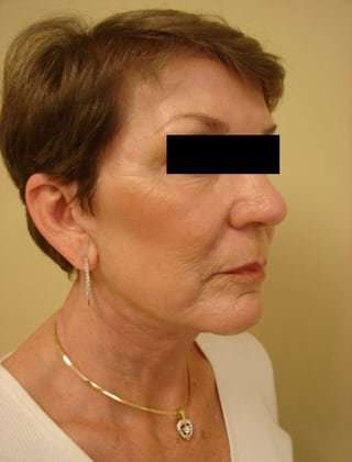 Facelift Before & After Patient #411