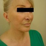 Facelift Before & After Patient #416