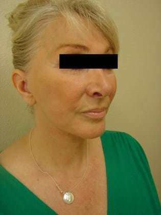 Facelift Before & After Patient #416