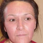 Laser Resurfacing Before & After Patient #149