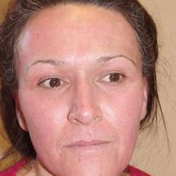 Laser Resurfacing Before & After Patient #149