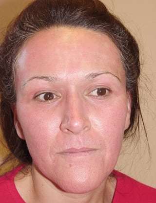 Laser Resurfacing Before & After Patient #149