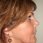 Brow Lift Before & After Patient #422