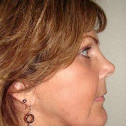 Brow Lift Before & After Patient #422