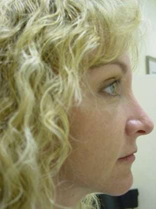 Brow Lift Before & After Patient #428