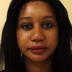 Brow Lift Before & After Patient #431