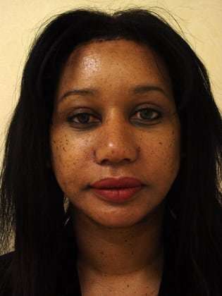 Brow Lift Before & After Patient #431