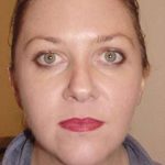 Brow Lift Before & After Patient #440