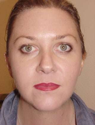 Brow Lift Before & After Patient #440