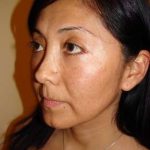 Blepharoplasty Before & After Patient #443