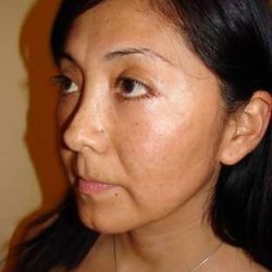 Blepharoplasty Before & After Patient #443